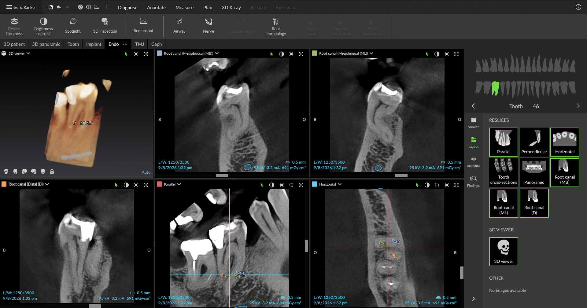 3D snimanje za endodonciju Beograd Centar