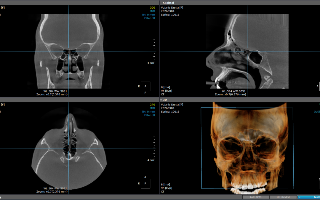snimanje nosa cbct